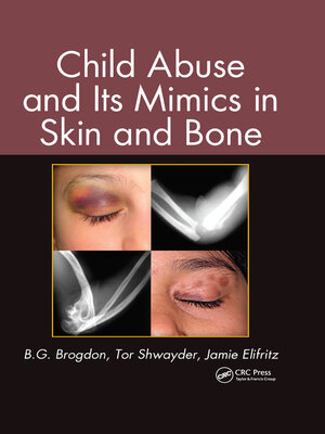 cover image of Child Abuse and its Mimics in Skin and Bone
